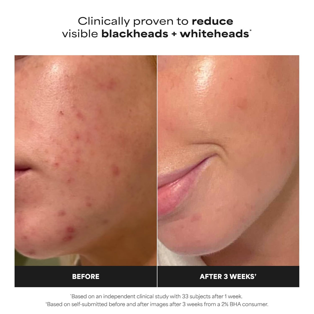 Paula's Choice SKIN PERFECTING 2% BHA Liquid Exfoliant with Salicylic Acid, Facial Polish for Pores